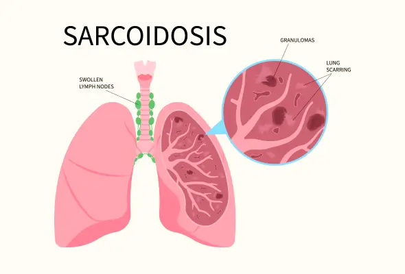 Sarcoidosis
