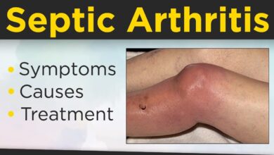 Septic Arthritis