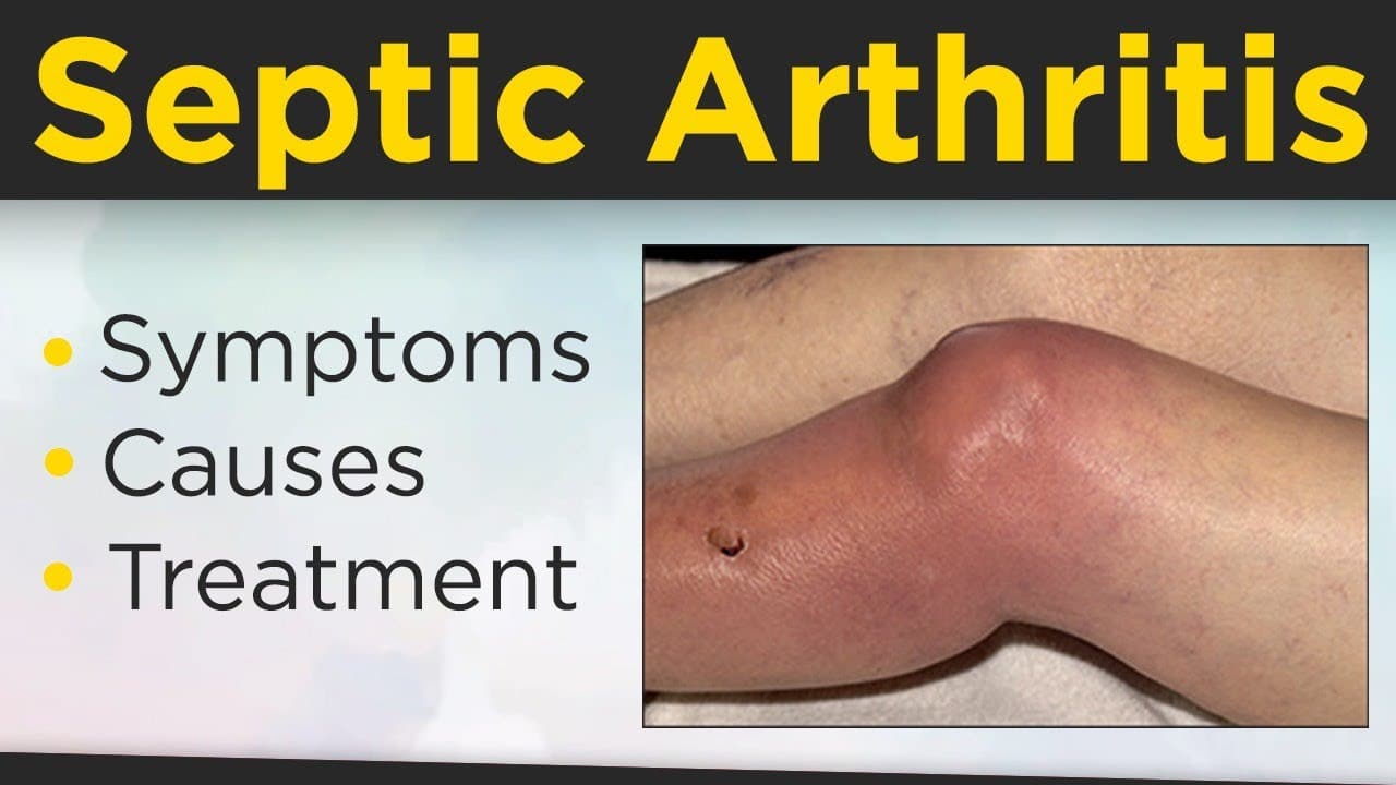 Septic Arthritis