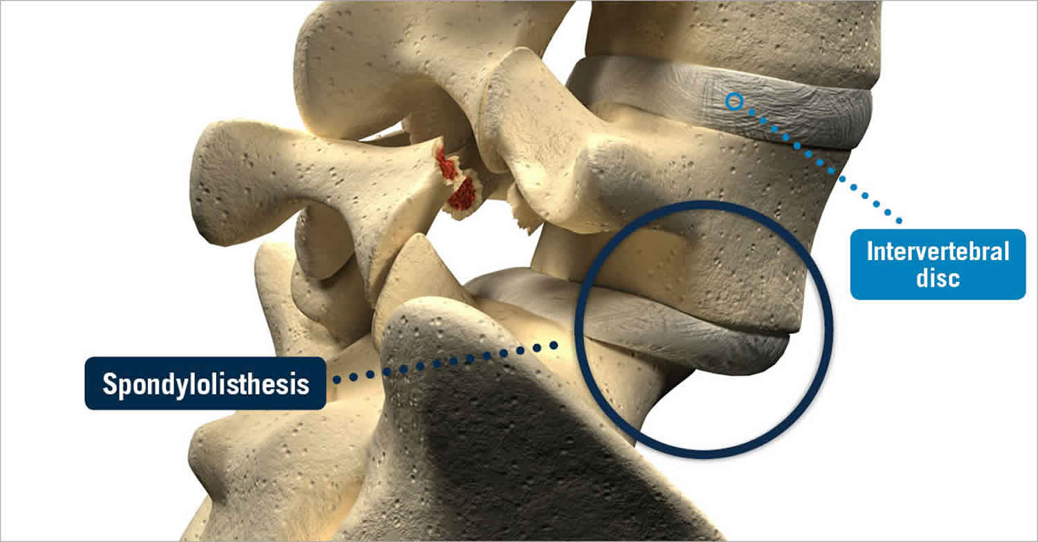 Spondylolisthesis