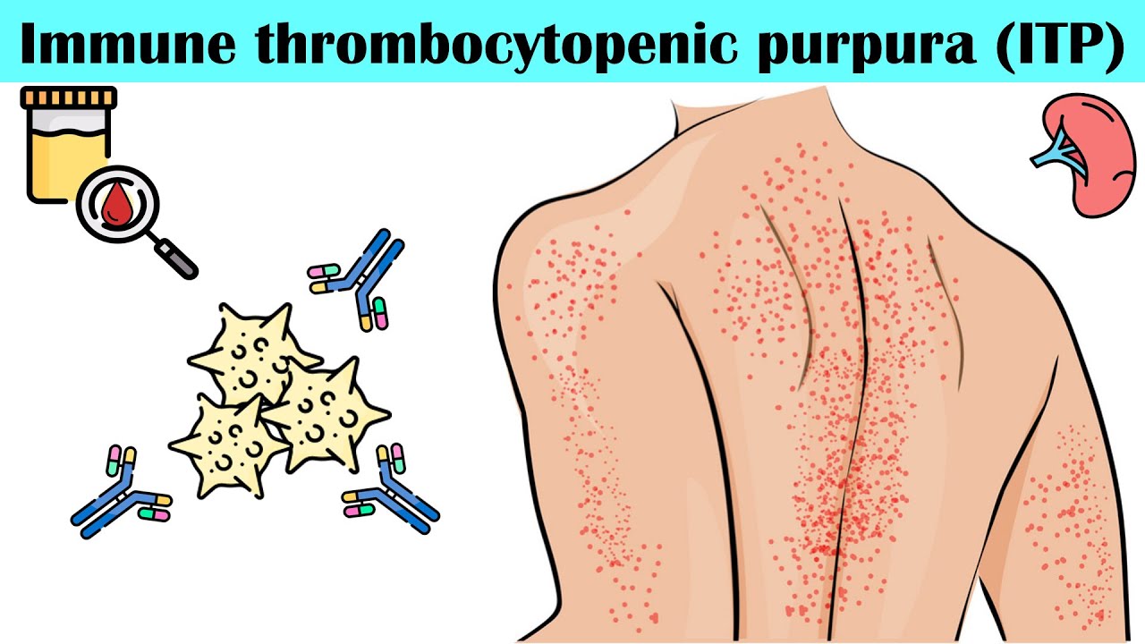 Thrombotic Thrombocytopenic Purpura
