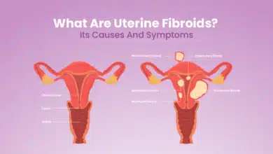 Uterine Fibroids