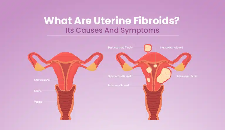 Uterine Fibroids