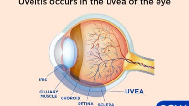 Uveitis