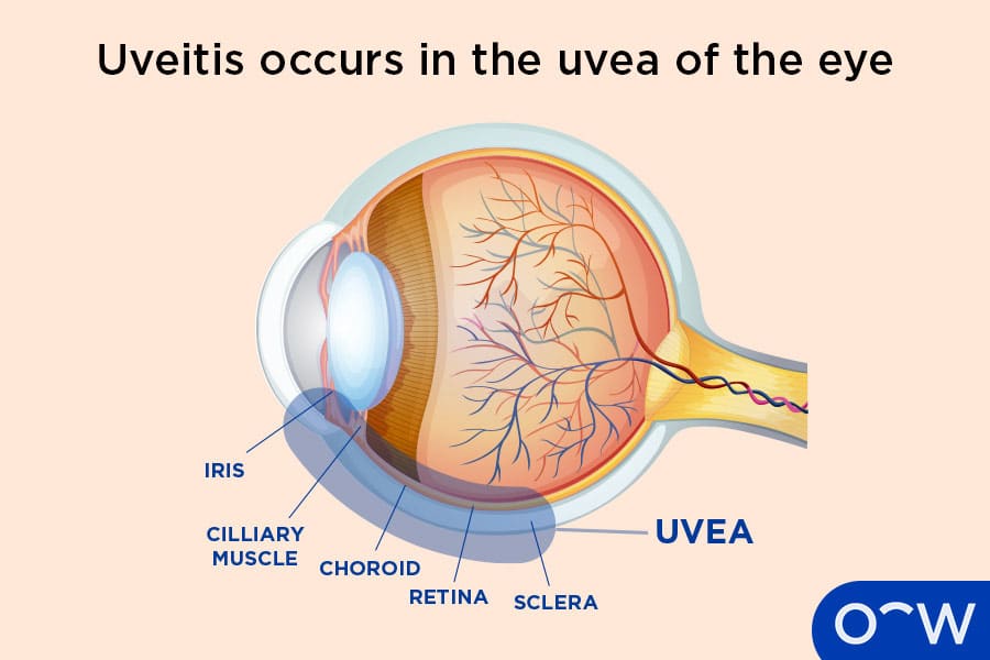 Uveitis