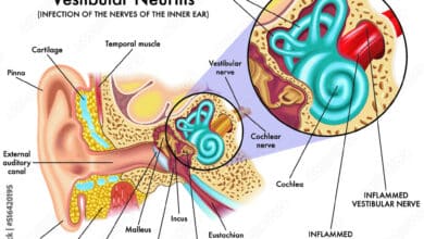 Vestibular Neuritis