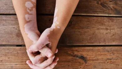Vitiligo