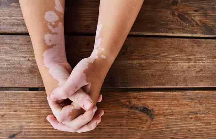 Vitiligo