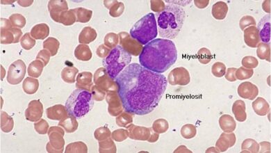 Acute Myeloid Leukemia
