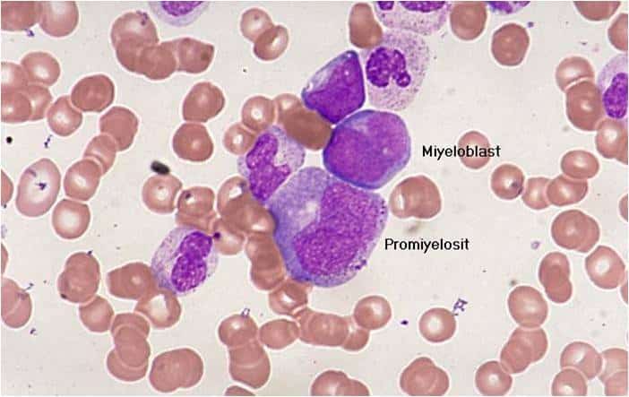 Acute Myeloid Leukemia