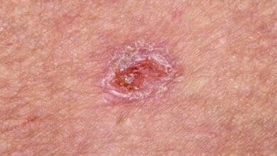 Basal Cell Carcinoma