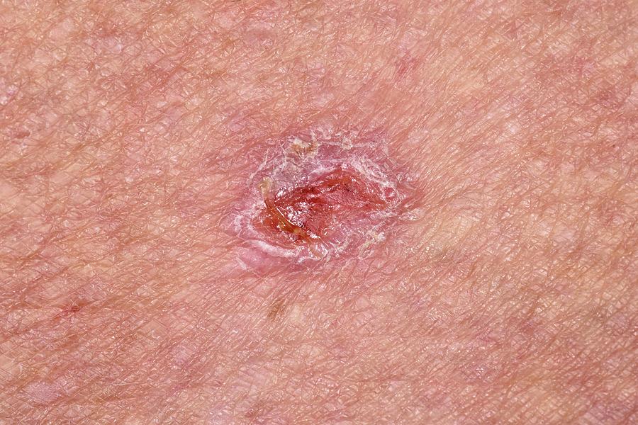 Basal Cell Carcinoma