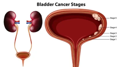 Bladder Cancer