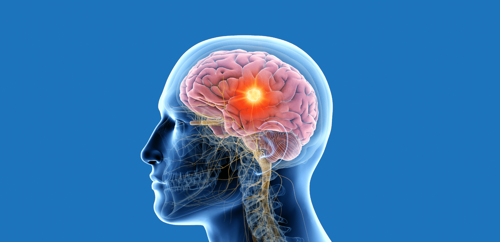 Brain Tumors