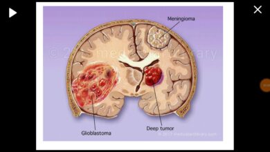 Glioblastoma Multiforme