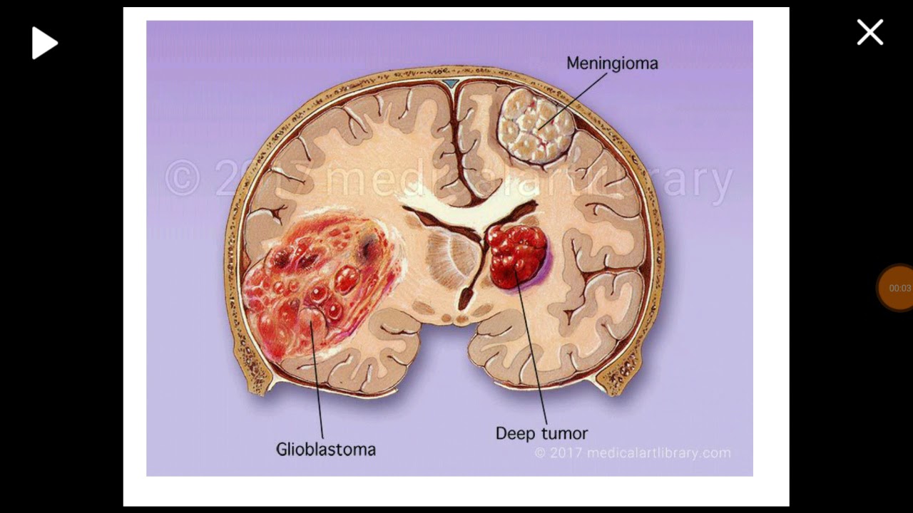 Glioblastoma Multiforme