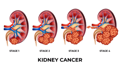Kidney Cancer