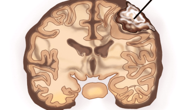 Meningioma