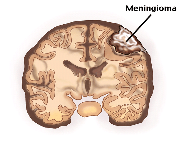 Meningioma