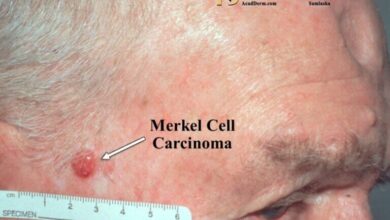 Merkel Cell Carcinoma