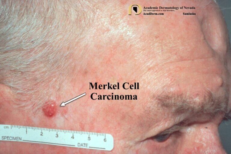 Merkel Cell Carcinoma