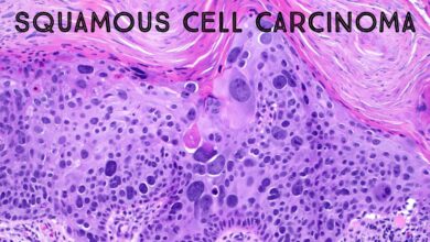 Squamous Cell