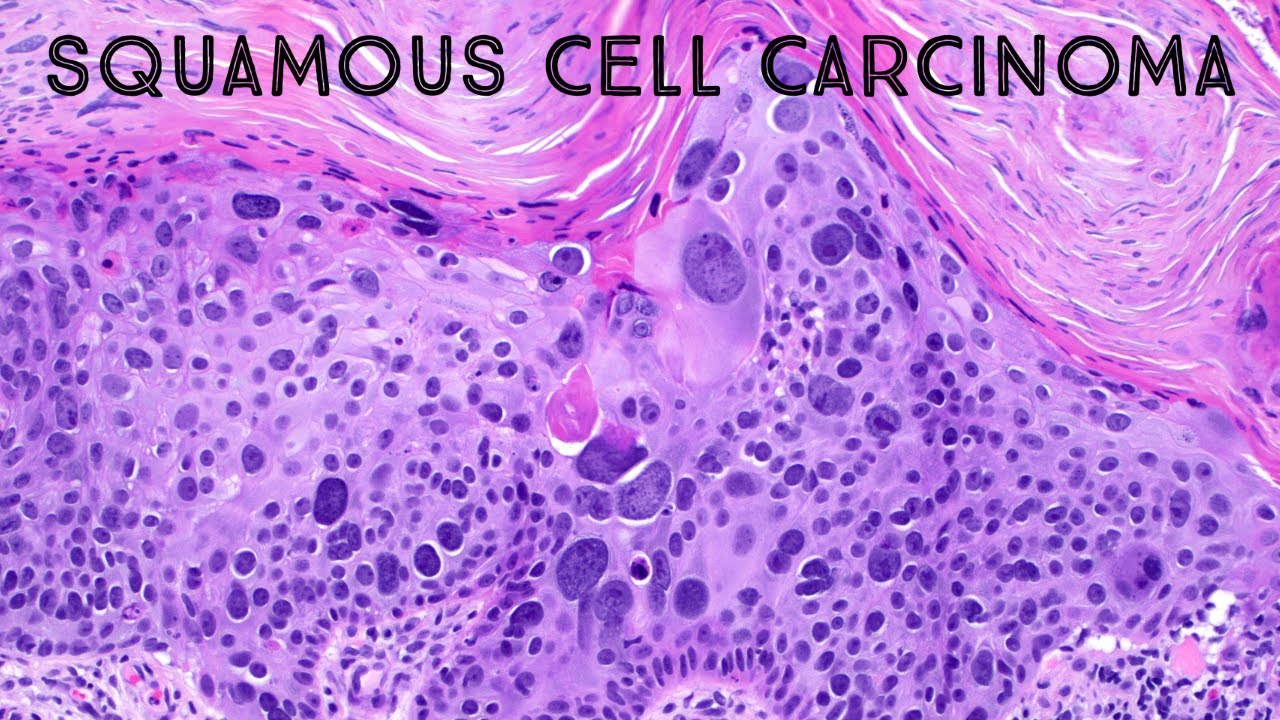Squamous Cell