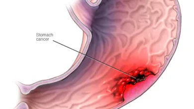 Stomach (Gastric) Cancer