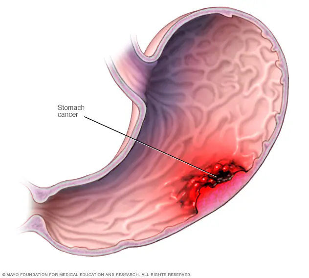 Stomach (Gastric) Cancer