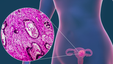 Uterine (Endometrial) Cancer