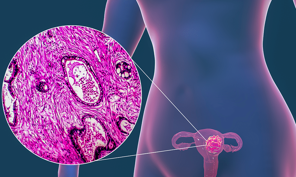 Uterine (Endometrial) Cancer