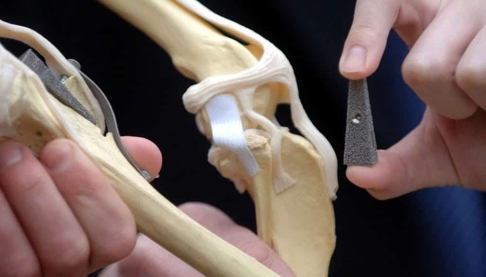 India Advances Medical Tech with 3D Printed Bone Grafts