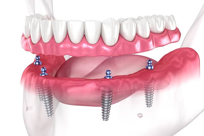 Revolutionary Bi-layered Dental Implants Set to Transform Oral Health